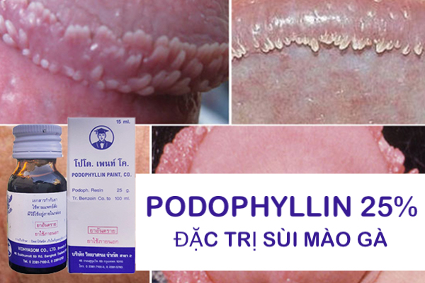 Thuốc Podophyllin 25 Thái Lan trị sùi mào gà nhanh an toàn nam nữ