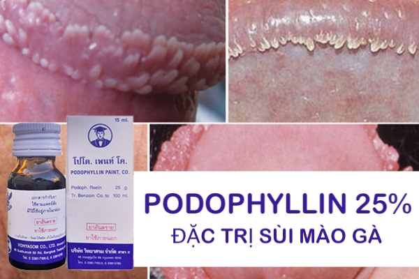  Bán Thuốc Podophyllin 25 Thái Lan chữa trị sùi mào gà tại nhà cho nam nữ hàng xách tay